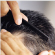 Hair Loss Treatments